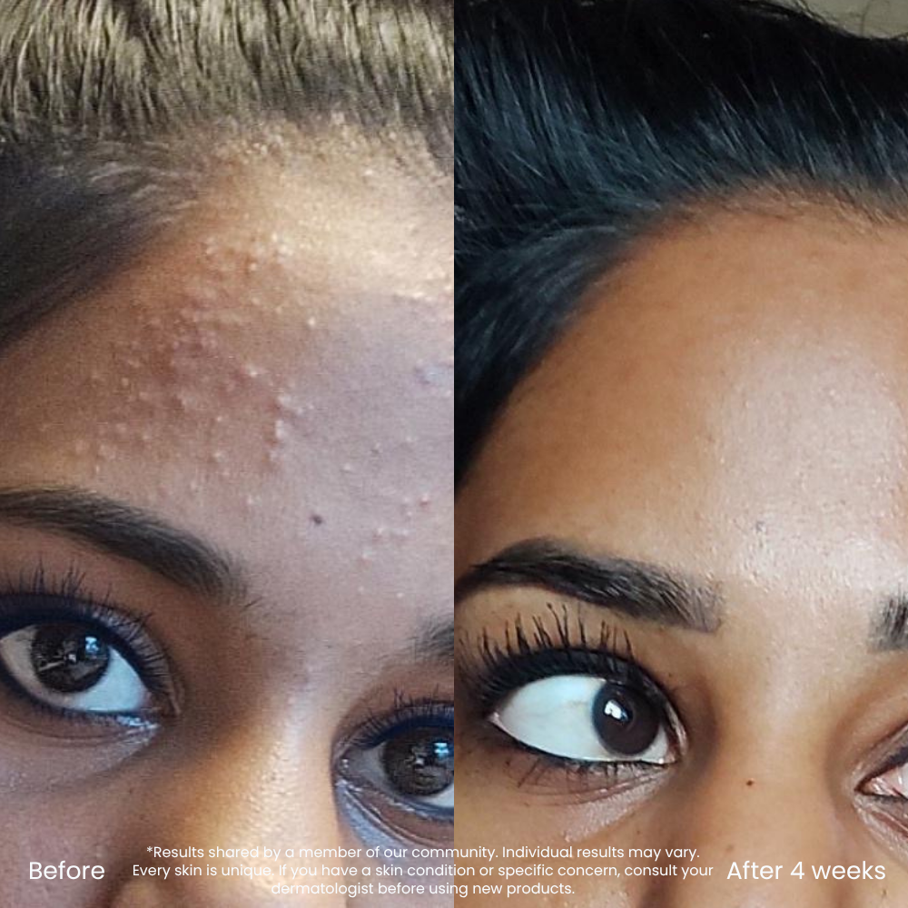 BHA/AHA Exfoliant For Pores & Uneven Skin Texture