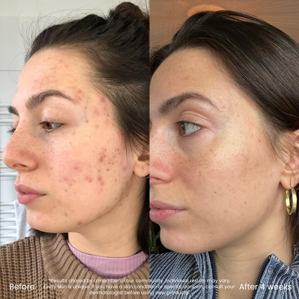 BHA/AHA Exfoliant For Pores & Uneven Skin Texture