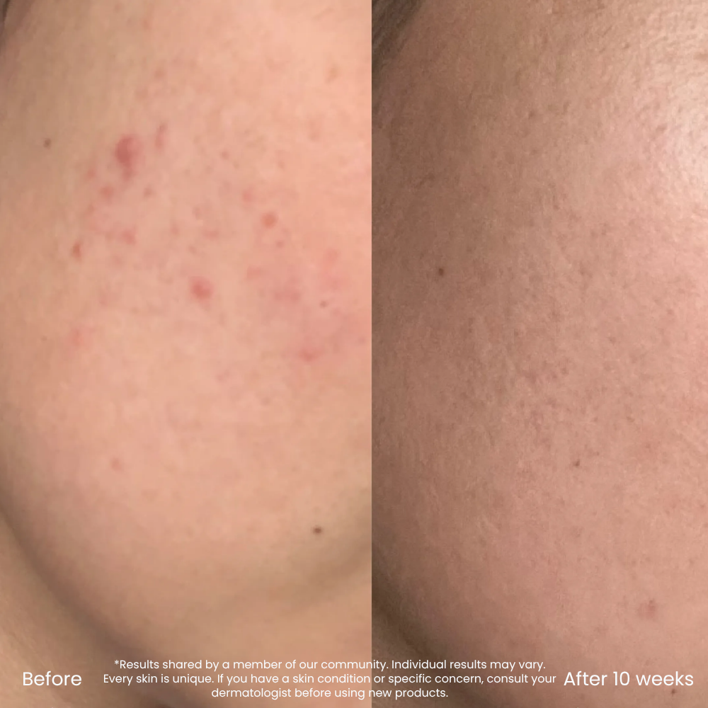 Triple AHA Clarifying Cleanser For Blemishes & Clear Skin