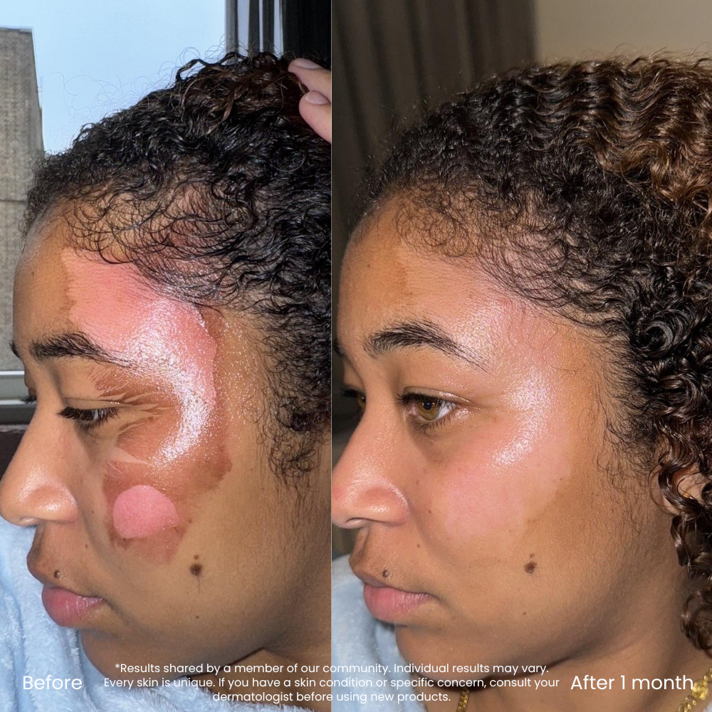 Dark Spot And Redness Correcting Vitamin C Serum