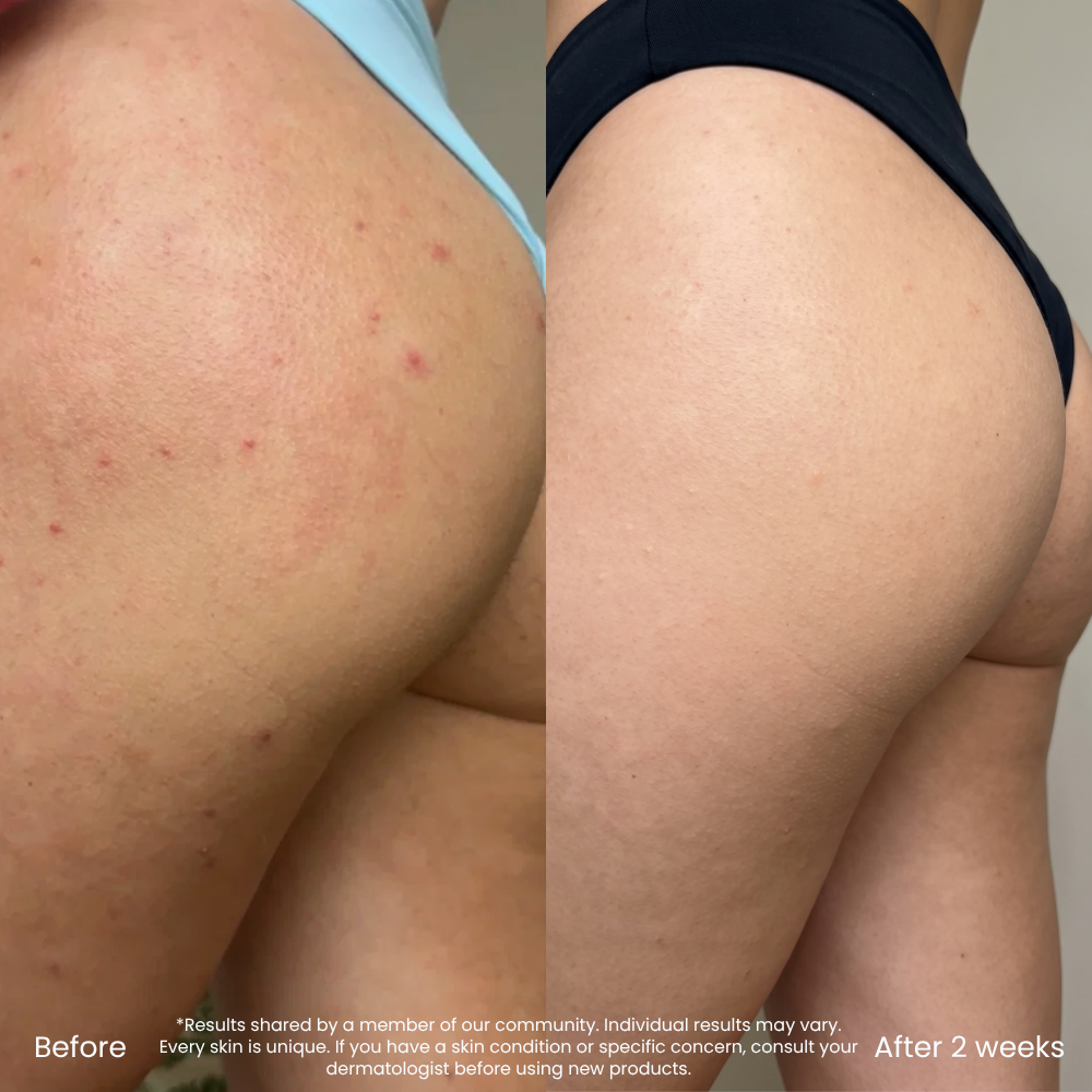 Soothing Body Lotion For Butt Pimples And Bumps